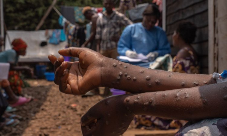 OMS autoriza uso emergencial de vacina japonesa contra MPOX